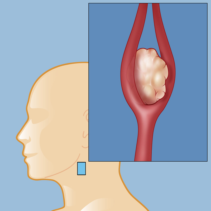 carotid body tumor lg